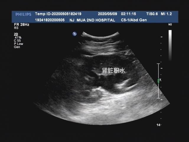 1分钟泌尿外科医生带你简单了解什么是泌尿系彩超