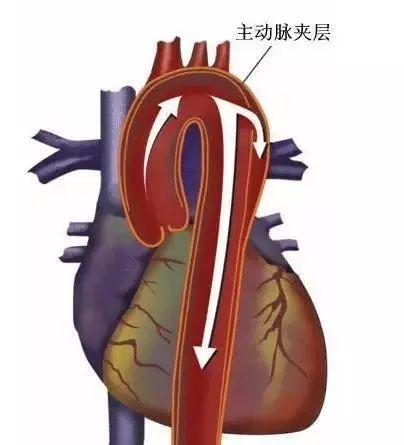 58岁男子突发胸痛，检查体征都指向心梗，上了手术台一看，竟然是误诊……