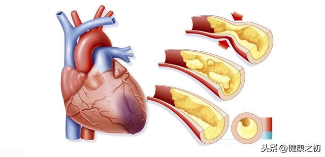 53岁心梗离世！医生说：他血管狭窄才60%，3次机会都错过了