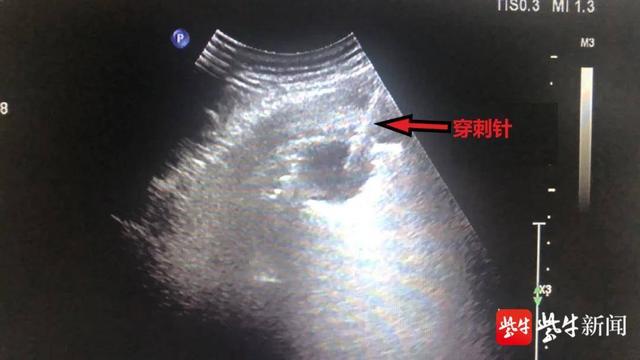 活检|肺癌？这种穿刺活检可以给无法常规检查的老人“定性”