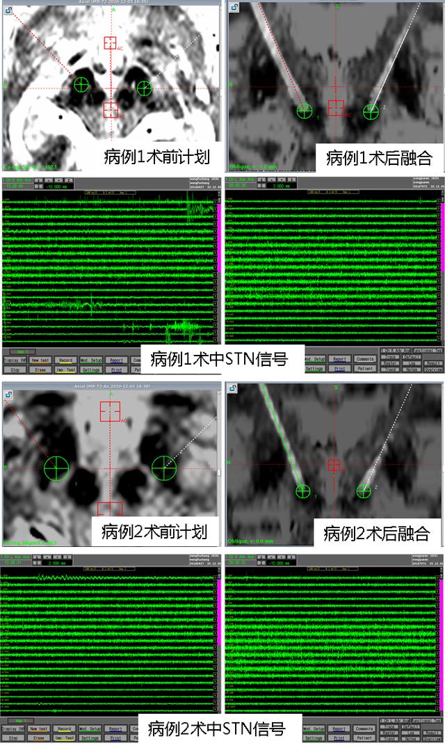 李卫国教授团队顺利开展DBS日间/加速康复外科手术治疗帕金森