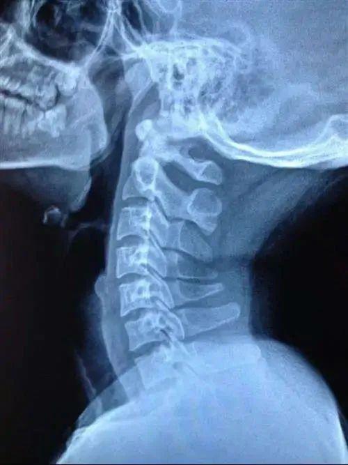 孩子|拿什么拯救孩子的颈椎？