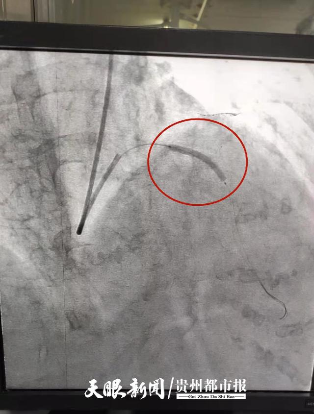 “百元”心脏支架落地贵州！患者：能省一大笔钱，太开心啦