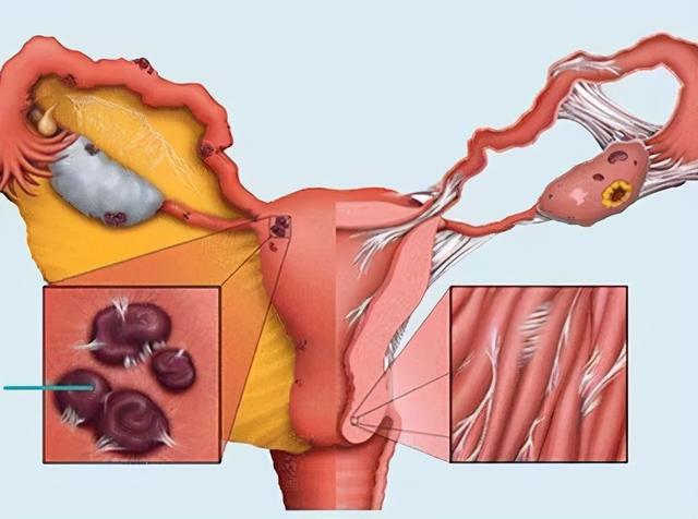 卵巢囊肿还有这么多种？