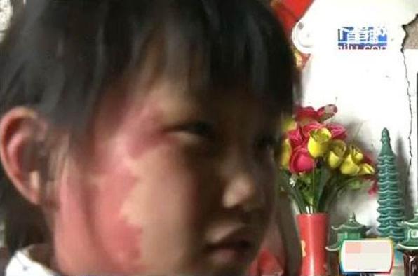 你的育儿经|胎记是怎么回事？产科医生：除遗传，怀孕时这3种行为注意避开