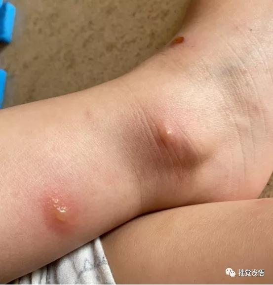 超级宝妈|小儿黄水疮