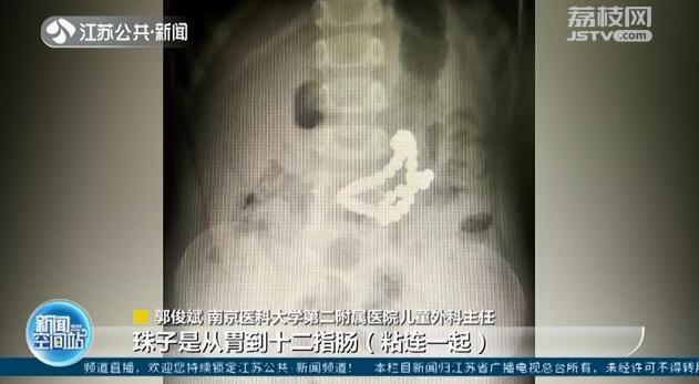 【你的育儿经】3岁男童吞下41颗磁力珠 导致两处胃穿孔 医生紧急手术救命