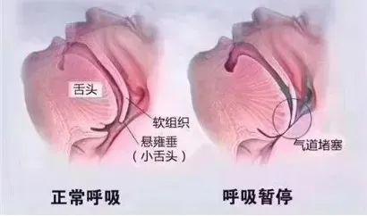 呼吸|打呼噜是睡的香吗？一男子睡着呼噜作响，竟“断气”432次