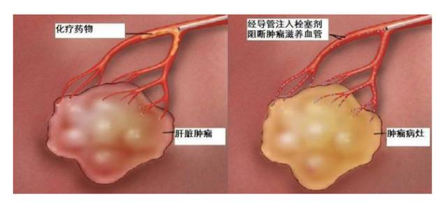 我院成功实施首例&quot;经皮肝动脉化疗栓塞术&quot;