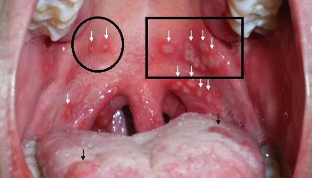 逗比大家庭|疱疹性咽峡炎又到高发期！别与手足口病、口腔溃疡搞混了