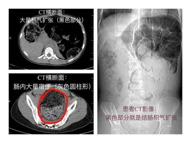 医生|高二姑娘肚子疼痛难忍，差点切肠！没想到竟是8斤这个堵住了......