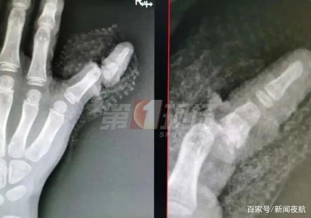 婉转应和|4岁女童手指被夹断！家中这个细节务必注意