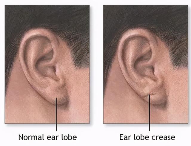 耳朵有折痕，就是心梗？医生辟谣：要是真的，就不用花钱做检查了