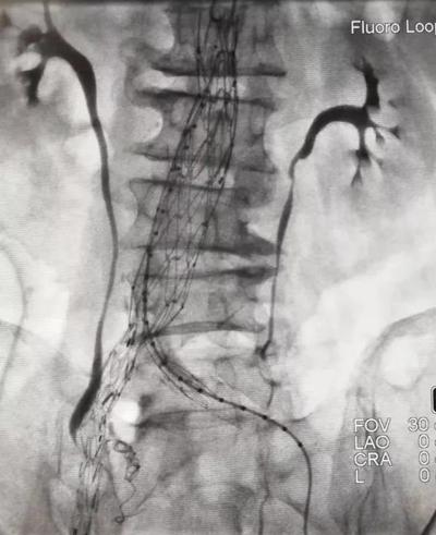 患者|长治二院成功完成一例腹主动脉瘤微创腔内