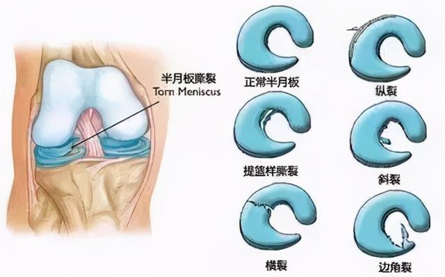 经常性膝关节疼痛有可能是半月板出了问题——解析半月板