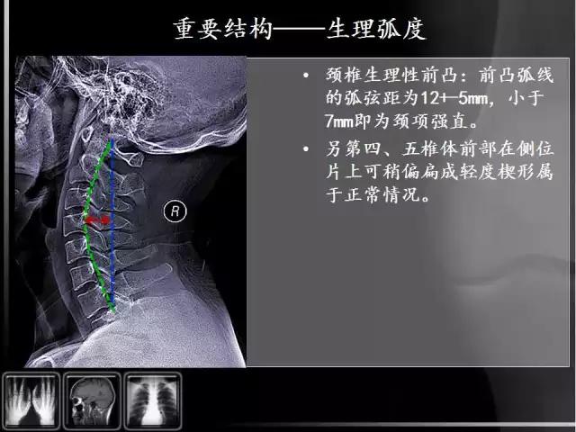 通俗易懂的脊椎X光片读片指南，值得收藏