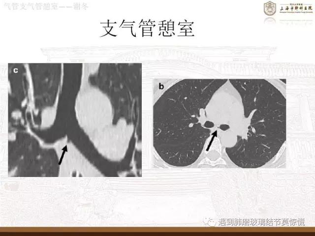 遇到气管、支气管憩室莫惊慌