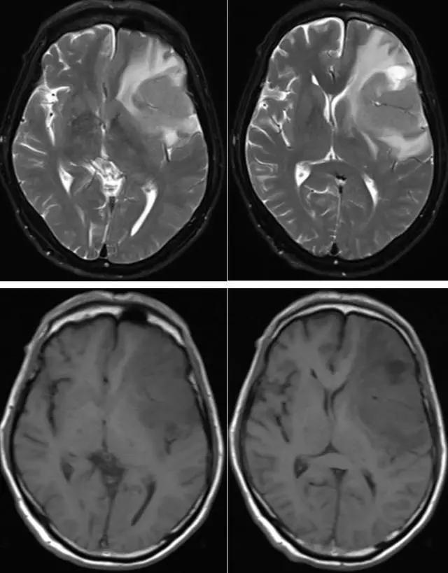 颅内原发性淋巴瘤的影像诊断要点