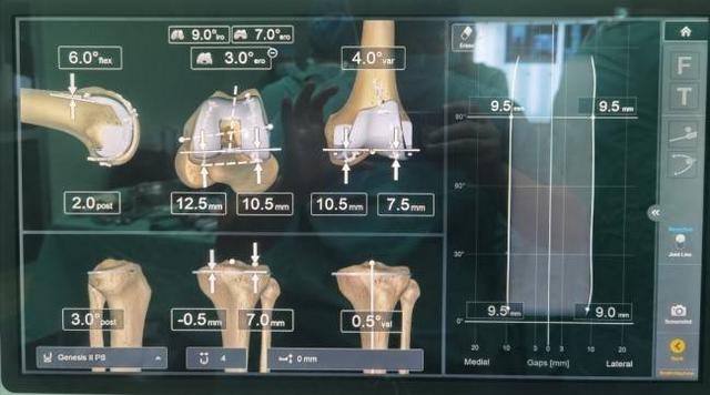 精准度从毫米级提高至亚毫米级，攀枝花市中心医院完成西南地区首例机器人导航全膝关节