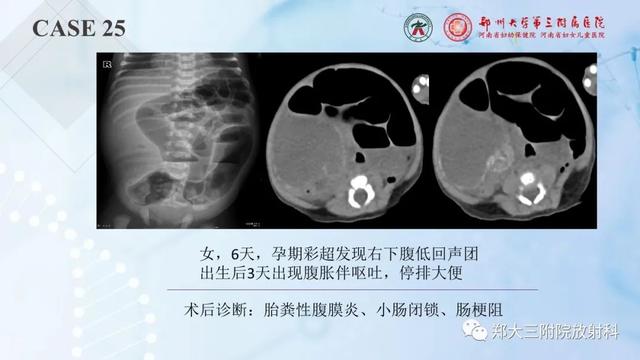 儿童腹部囊性病变诊断思路分析