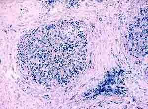 皮肤色素沉着|带你认识一种容易被忽略的肝病：血色病也是肝硬化的重要原因之一