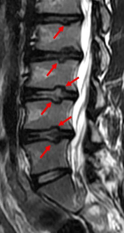 拿到片子不会看？6 种「椎间盘突出」的影像征象需注意