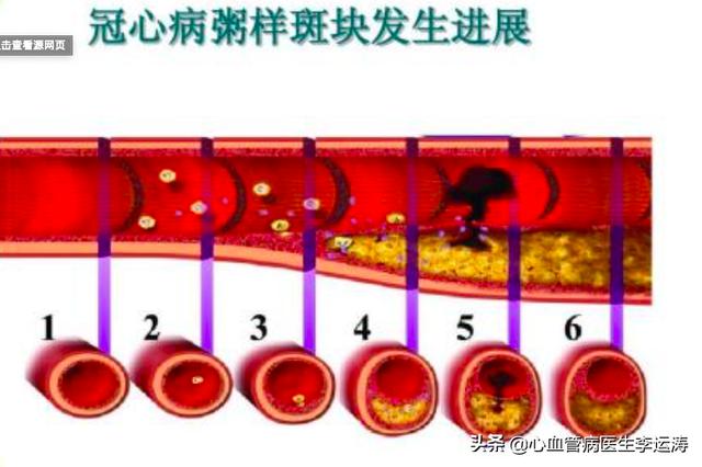 动脉粥样硬化|冠心病，吃什么药好呢？