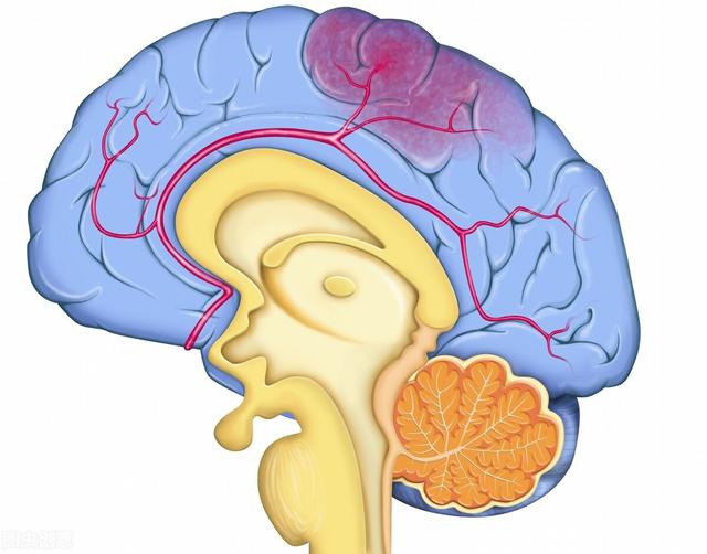 脑出血发病前，会有先兆吗？哪些症状可能提示大脑出血了？医生讲