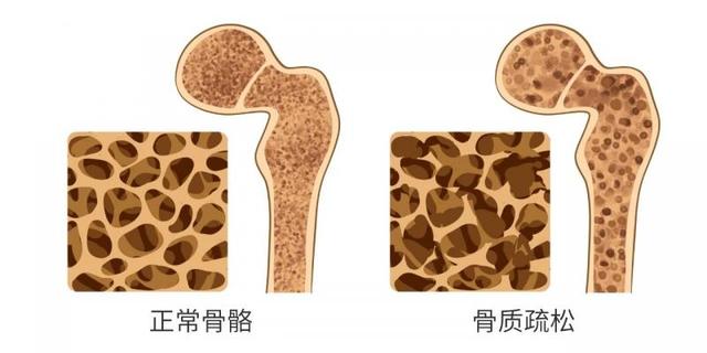 五十岁女性，如何补钙对抗骨质疏松？哪些细节要注意？医生告诉您