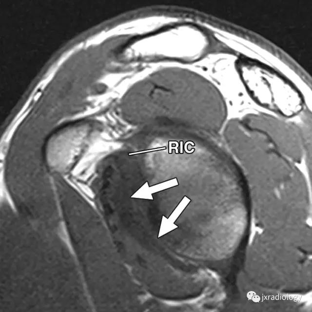 肩袖间隙的解剖及常见病变
