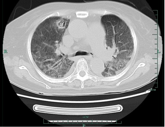 大姐反复发烧两个月！医生：这种致病菌每个人口中都有……