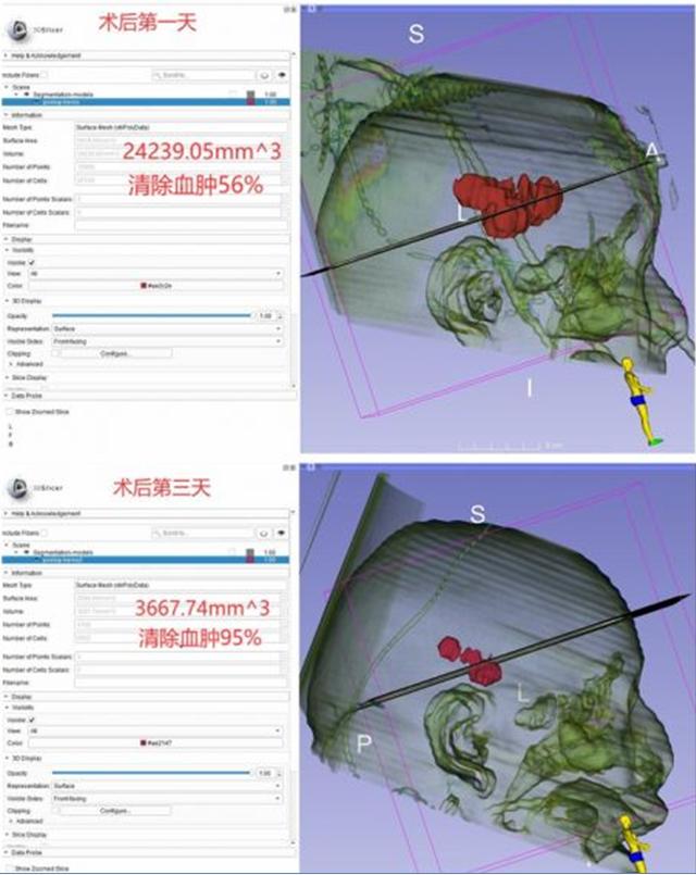 手术|湘西州人民医院：3D数字医学工程技术精准治疗抗凝药物相关性脑出血