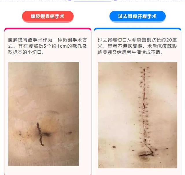 患者|新平台 新力量丨孙静锋——腹腔镜胃癌手术