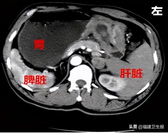 镜面|给福建首个胃癌“镜面人”做手术是什么体验？他们说：就像“脑筋急转弯”