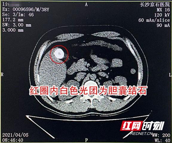 胆囊|男子参加公司体检 没想到胆囊里发现个“黑橄榄”结石