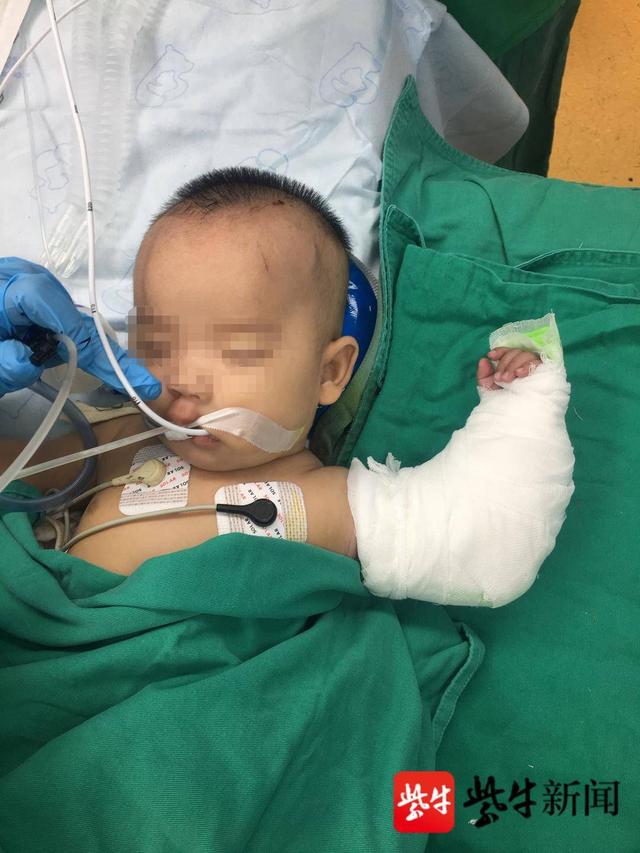 手术|三个月大孩子断了胳膊，这是医生见过全国最小的不全断臂患者