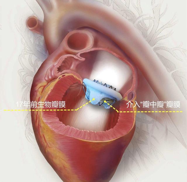 手术|80岁老太二次换瓣补“心门”！港大深圳医院为其植入“瓣中瓣”