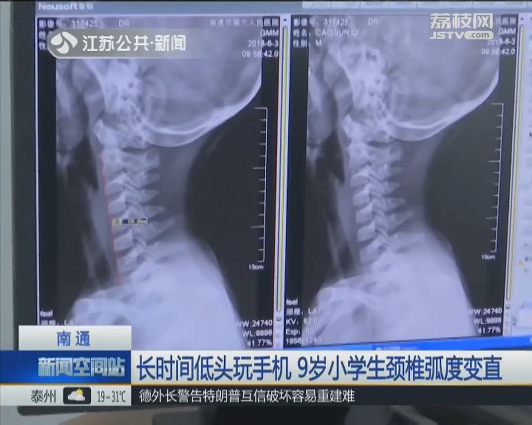 #文字上的青年#9岁小学生颈椎变成一条直线，家长发现时已晚了！很多孩子都有这习惯