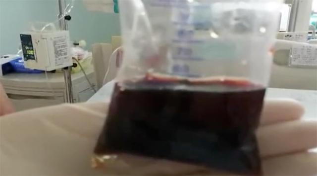 [超级宝妈]3岁宝宝尿出酱油色 爸妈怕被隔离不敢送医！结果差点……