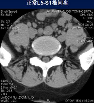 腰椎间盘CT诊断：椎间盘膨出、突出、椎管狭窄及退行性病变