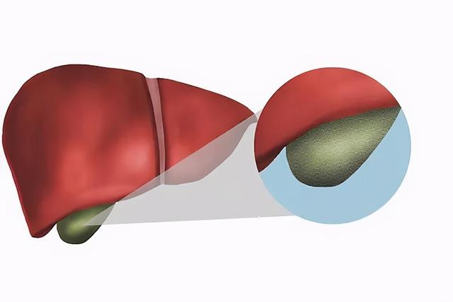 胆囊癌到访，早期身体会有3个征兆，就算发现一个，也别轻视