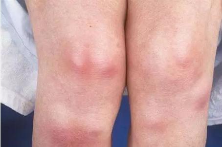 一家四口儿|怀孕长了黄褐斑？这些常见妊娠皮肤病，危及宝宝健康