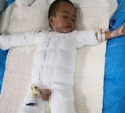 超级宝妈■2岁男童摔进滚烫油锅：有一种可恶叫逗孩子玩，伤害超乎你的想象