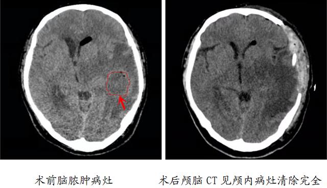 中耳炎|中耳炎可能导致颅内感染？烟台山医院提醒：勿以病小而不医