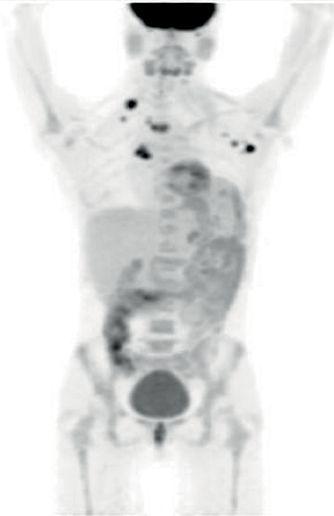 打破传统治疗标准！拉罗替尼挑战转移性非小细胞肺癌的一线治疗