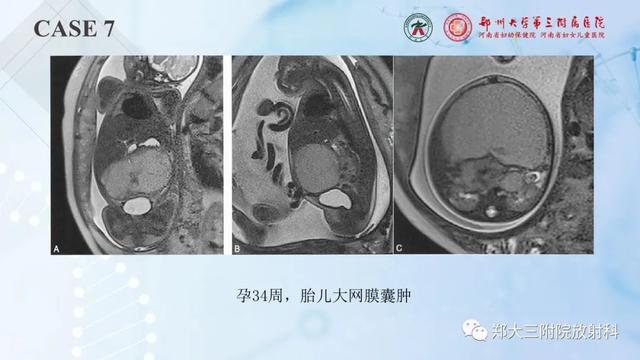 儿童腹部囊性病变诊断思路分析