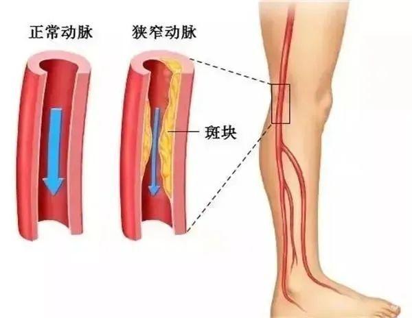 下肢|提醒：腿上出现这个东西，要小心了