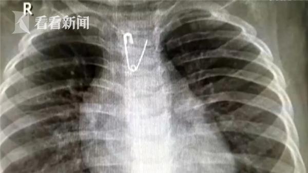 超级宝妈|10个月宝宝误吞别针！妈妈三步“教科书式”做法救了孩子