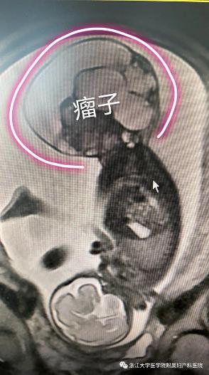 你的育儿经|生死时速！宝宝身上拖着“巨型炸弹”医生和胎盘“抢时间”