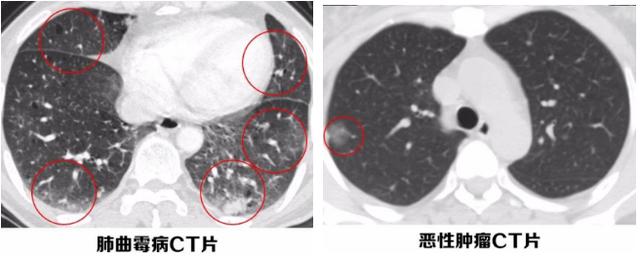 肺部微小结节就像痣和雀斑难消除，但有3种易消失却常被误认为癌